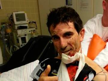 Coloma, intervenido con éxito de su fisura en la cabeza humeral